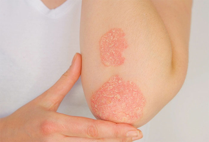 Lupus ban đỏ và vảy nến khác nhau như thế nào?
