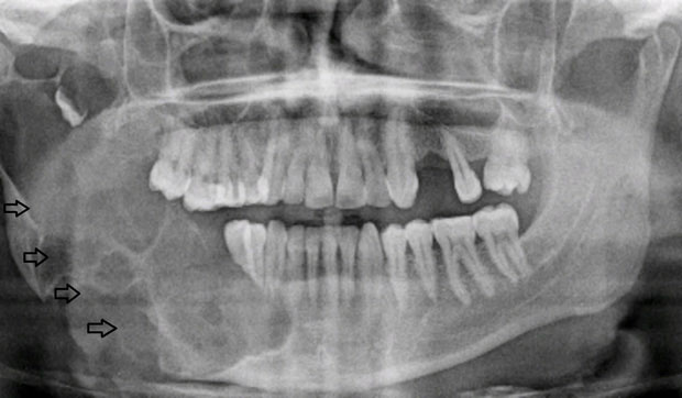 Khối u men răng có thể liên tục phát triển và xâm lấn một cách âm thầm.