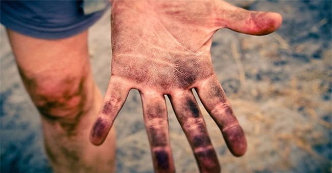 Kỳ lạ những người hoàn toàn không có dấu vân tay