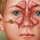 Viêm xoang ở trẻ em: Nguyên nhân, triệu chứng và cách điều trị