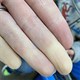 Bệnh mùa lạnh khiến ngón tay trắng bệch một cách kỳ lạ