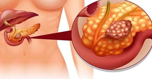 Top 14 bệnh ung thư nguy hiểm nhất hiện nay