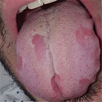 "Covid lưỡi", triệu chứng mới của đại dịch