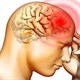Bệnh phù não: Nguyên nhân, triệu chứng và cách điều trị