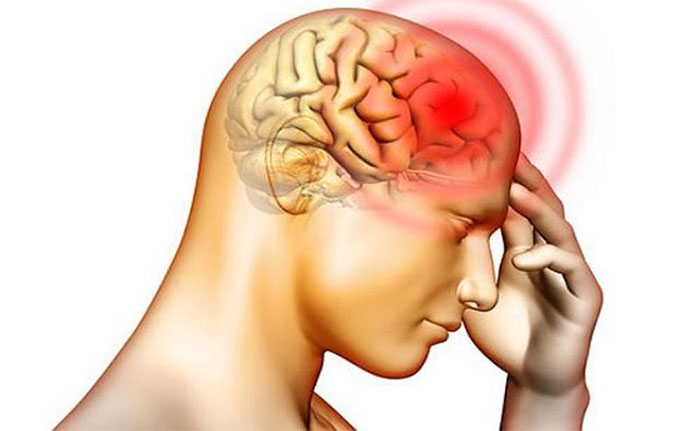 Bệnh phù não: Nguyên nhân, triệu chứng và cách điều trị