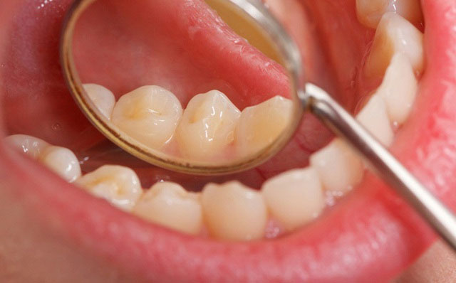 Dấu hiệu cảnh báo ung thư khoang miệng