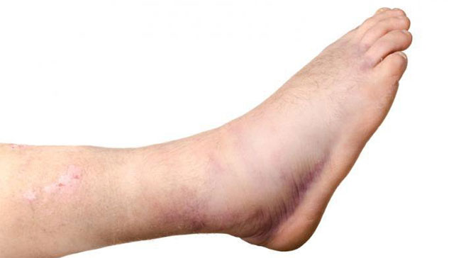 Cách phân biệt bong gân và sai khớp