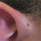Rò luân nhĩ: Nguyên nhân, triệu chứng và cách điều trị