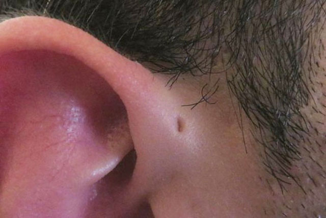 Rò luân nhĩ: Nguyên nhân, triệu chứng và cách điều trị