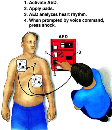 Minh họa cách sử dụng AED.