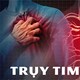 Trụy tim: Nguyên nhân, triệu chứng và cách điều trị