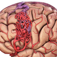 Đột biến gene - nguyên nhân gây dị dạng mạch máu não thể hang