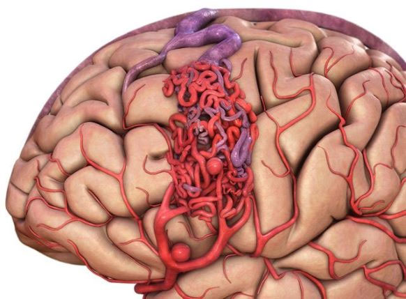 Đột biến gene - nguyên nhân gây dị dạng mạch máu não thể hang