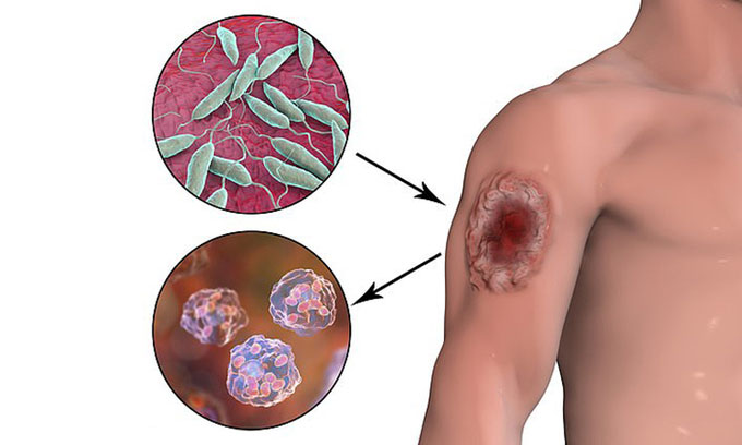 Mô phỏng ký sinh trùng Leishmania gây lở loét da.