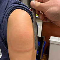 "Cánh tay Covid" - triệu chứng vô hại sau tiêm vaccine Moderna