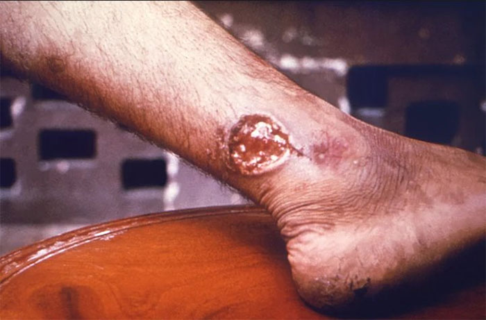 Vết thương do ký sinh trùng Leishmania gây ra
