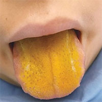 Rối loại tự miễn hiếm gặp gây vàng lưỡi và nước tiểu sậm màu ở trẻ em