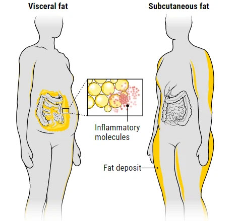 Những người tích mỡ nội tạng (bên trái) và mỡ dưới da (phải)