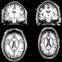 Nhiễm Covid-19 thể nhẹ có thể làm teo não