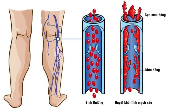 Di chứng tim mạch hậu Covid-19 nguy hiểm thế nào?