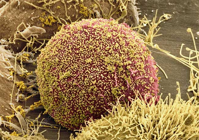  Virus HIV (màu vàng) bao quanh tế bào bệnh nhân.