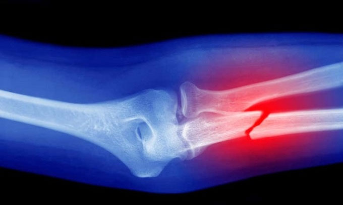 Nghiên cứu thử nghiệm dùng công nghệ vaccine để chữa lành xương