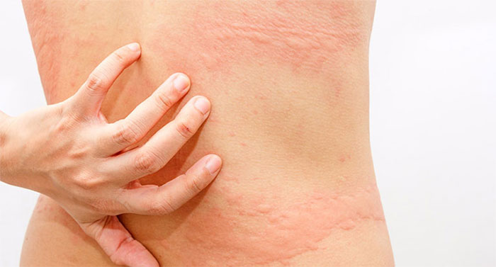 Nên làm gì khi trẻ bị nổi nốt đỏ như muỗi đốt?