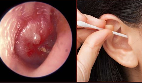 Vị trí ráy tai trong ống tai