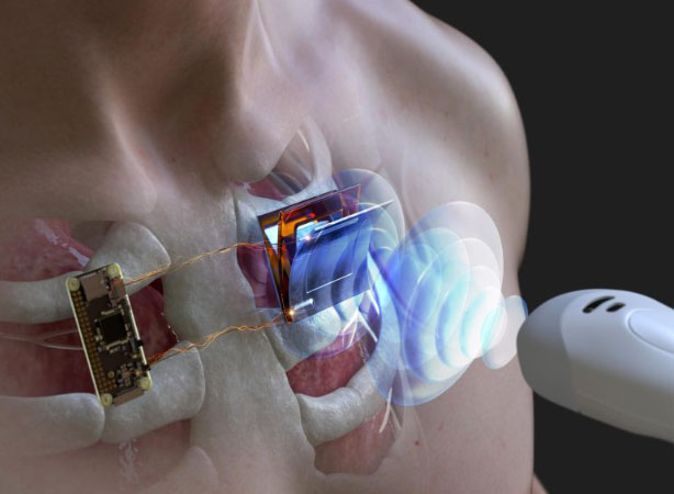 Nghiên cứu mới giúp sạc pin máy tạo ra nhịp tim mà không cần qua phẫu thuật