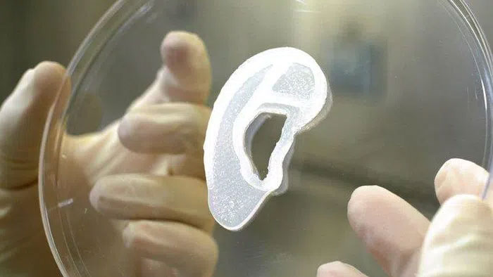 Lần đầu tiên trên thế giới: In 3D tai người, cấy ghép thành công cho cô gái