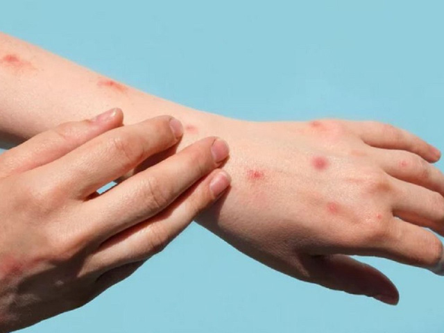 Rác thải y tế có thể khiến virus bệnh đậu mùa khỉ lây lan