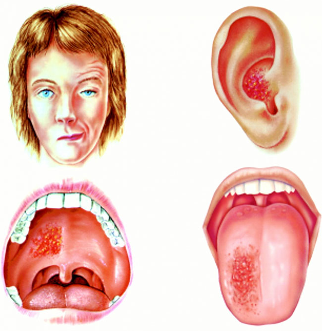 Hội chứng này có thể gây tê liệt một bên mặt và mất thính giác.