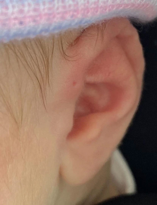 Có lỗ nhỏ trên tai