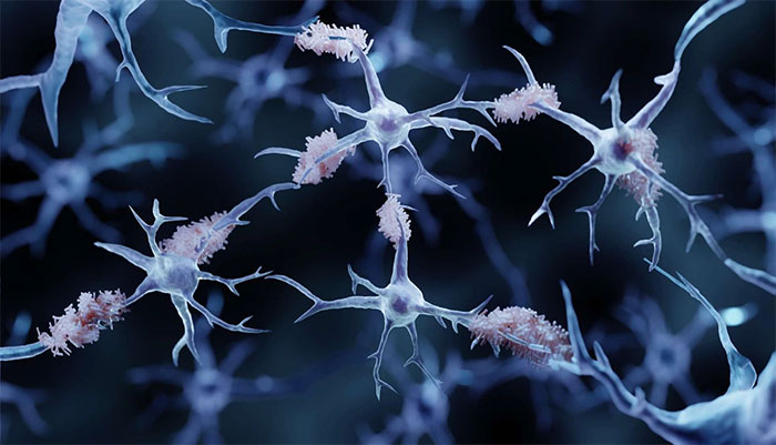 Truyền máu sẽ mở ra một hy vọng mới trong việc điều trị bệnh Alzheimer
