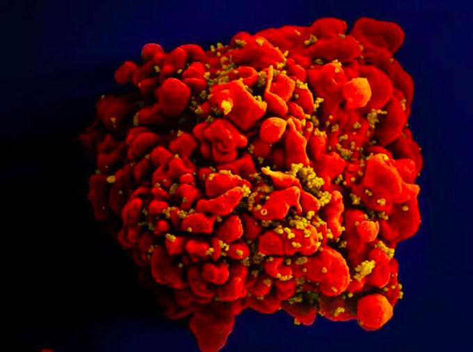 A cell infected by the HIV virus.