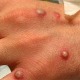 Bộ Y tế ban hành hướng dẫn chẩn đoán, điều trị và phòng bệnh đậu mùa khỉ