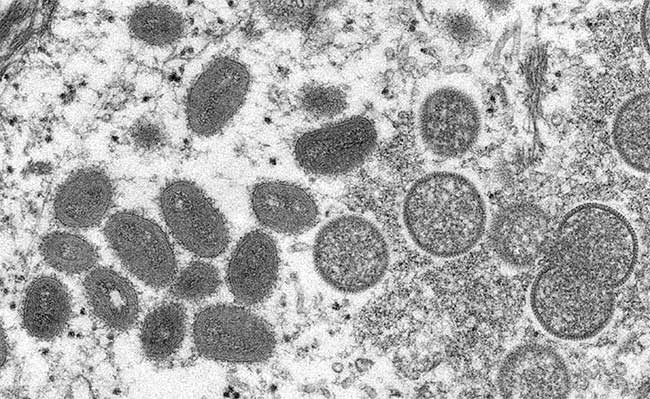 Hình ảnh dưới kính hiển vi cho thấy virus đậu mùa khỉ trong mẫu bệnh phẩm của một bệnh nhân.