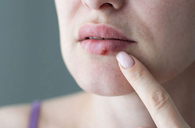Virus herpes có thể gây ra vết loét, mụn nước đau trên hoặc xung quanh miệng, môi.