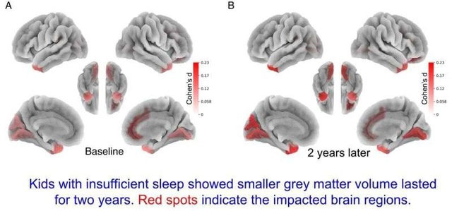 Trẻ ngủ dưới 9 giờ một đêm có ít chất xám hơn.