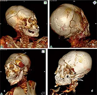 Phát hiện chấn thương trên xác ướp Nam Mỹ 1.000 năm tuổi, nạn nhân của những vụ giết người tàn bạo?
