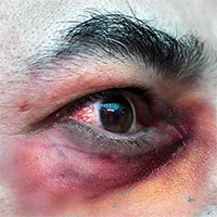 Bệnh nấm đen (Mucormycosis) là gì?