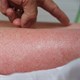 5 bệnh nguy hiểm tấn công người dân sau lũ