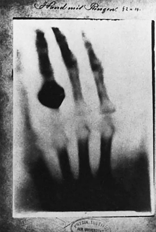 Tấm ảnh X-quang đầu tiên do Wilhelm Conrad Roentgen chụp lại.