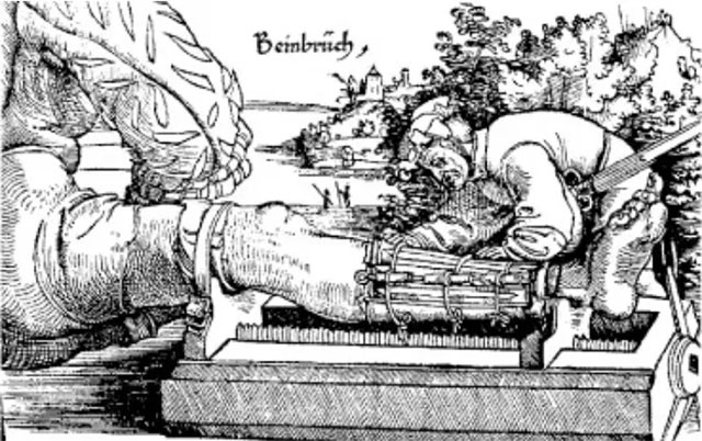  Hình minh họa việc dùng nẹp gỗ từ Gersdorf (1517). 