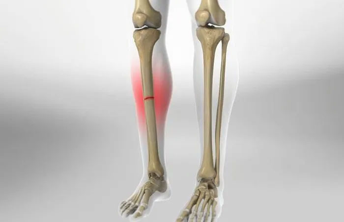 Phát hiện tế bào gốc giúp sửa chữa các chấn thương xương