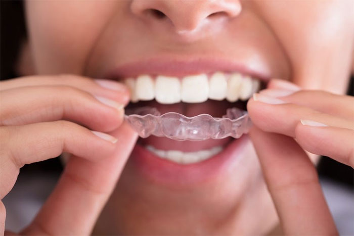  Dụng cụ bảo vệ miệng là công cụ hữu ích giúp giảm nghiến răng khi ngủ. 