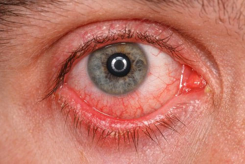 Viêm kết - giác mạc dị ứng (Atopic Keratoconjunctivitis)