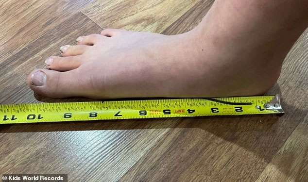 Cô bé 10 tuổi lập kỷ lục thế giới nhờ một bộ phận cơ thể lớn bất thường
