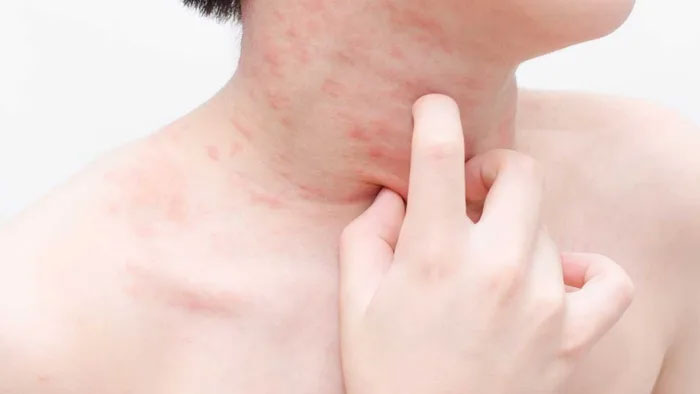 Sốc phản vệ do ăn trứng kiến: Những điều cần biết để bảo vệ sức khoẻ