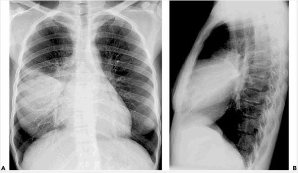 Viêm phổi do Mycoplasma có thể gây ra nhiều biến chứng, chẳng hạn như đông đặc phổi.